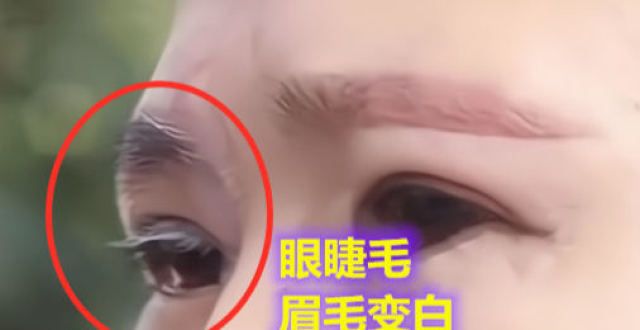 不要再留了女子割双眼皮后变“白眉侠”，找美容院讨要说法：是手术造成的今年冬